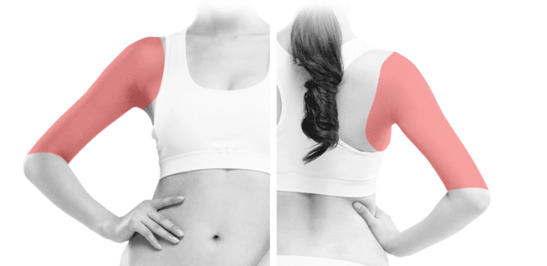 Arm Liposuction