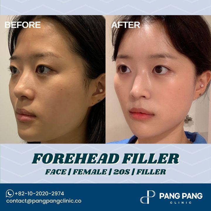 Achieve a youthful and smooth forehead with our precise filler treatments. Check out our before and after for incredible results.