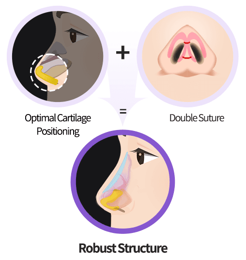Nose Implant