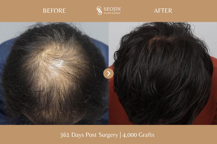 Seojin Plastic Surgery Clinic before and after image