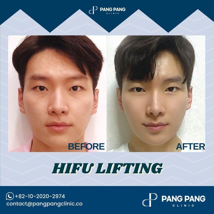 Discover the power of HIFU lifting at PangPang. A non-surgical route to a visibly lifted and contoured appearance, tailored for lasting beauty.
