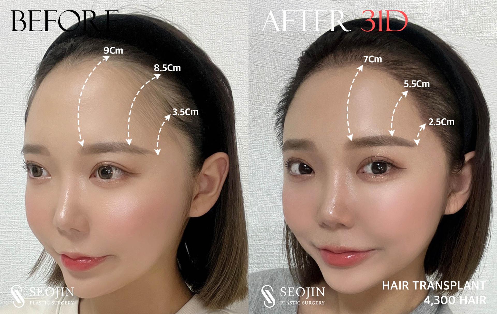 Hairline correction 31 days after surgery 4300 hair