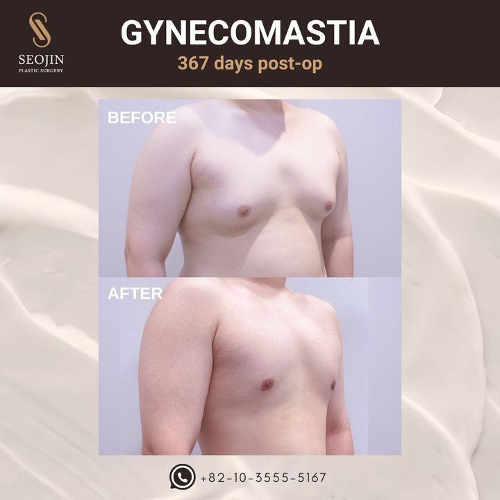 Seojin Plastic Surgery Clinic before and after image