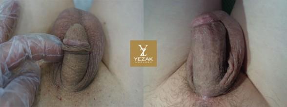 Comprehensive Penile Enhancement at Yezak Penis Enlargement + Penis Lengthening + Glans Enlargement + Premature Ejaculation Treatment + Erectile Dysfunction Treatment
