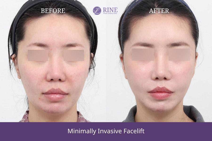 Minimally Invasive facelift