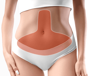 Tummy Tuck, Mommy Makeover