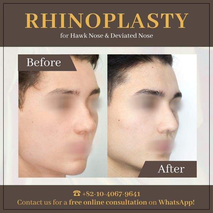 Korrigieren und perfektionieren Sie Ihr Profil mit einer Rhinoplastik. Unsere Vorher-Nachher-Fotos zeigen die Präzision unserer Techniken.