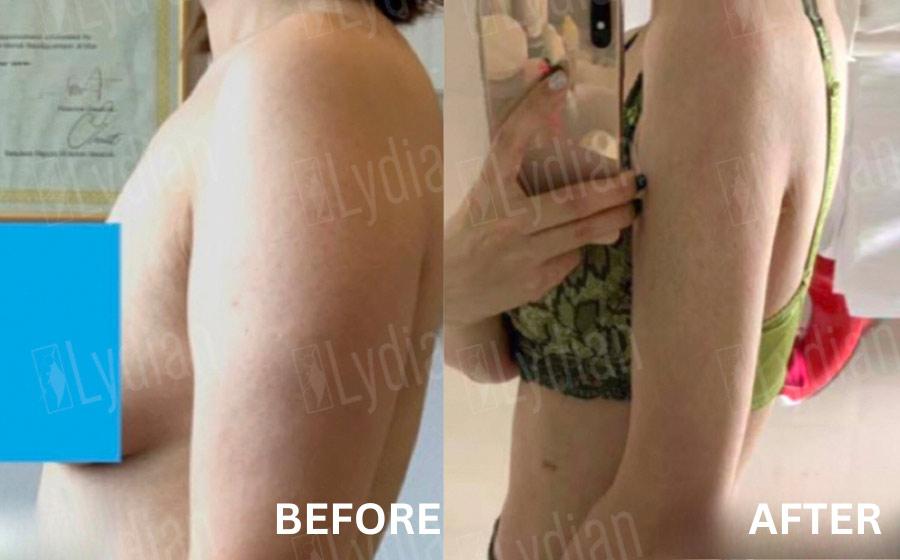 Vorher-Nachher-Bild der Lydian Plastic Surgery Clinic