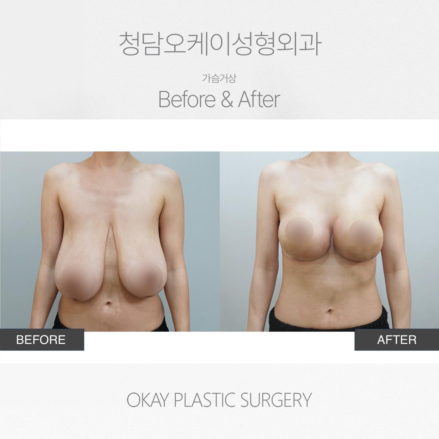Okay Plastic Surgery Clinic before and after image